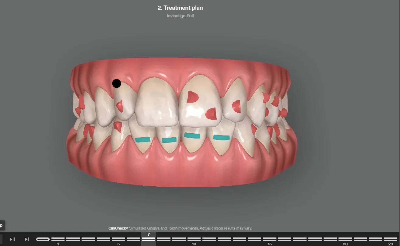 3D dental model showing an Invisalign Full treatment plan with movement markers on teeth and blue attachments.