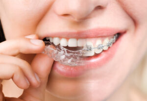 Close-up of a person inserting a clear aligner over braces on the upper teeth.