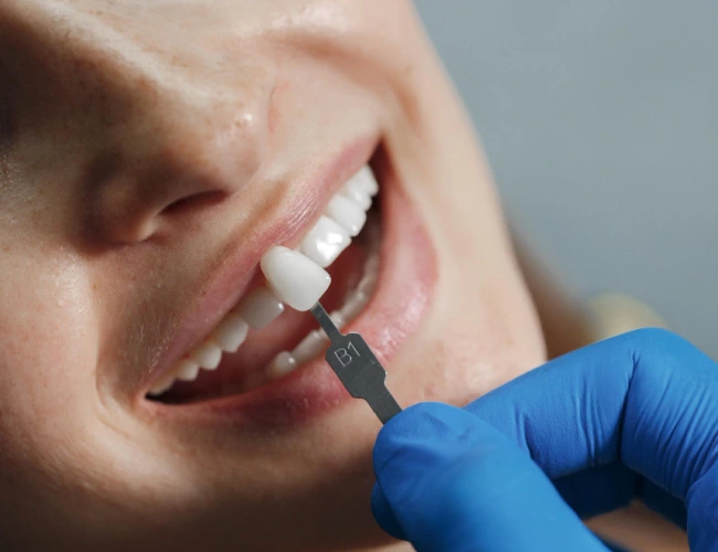 Close-up of a dentist's gloved hand holding a shade guide tooth against a patient's front tooth to match color for a veneer or crown.