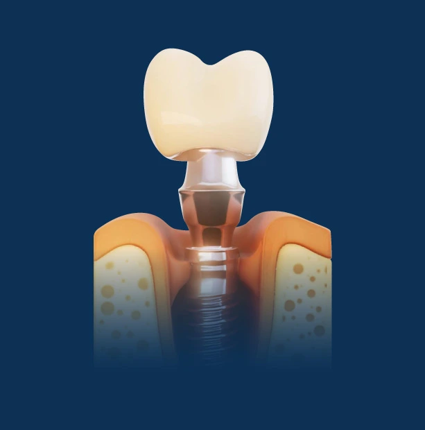 Cross-section of a dental implant showing a tooth crown attached to a titanium post anchored in the jawbone