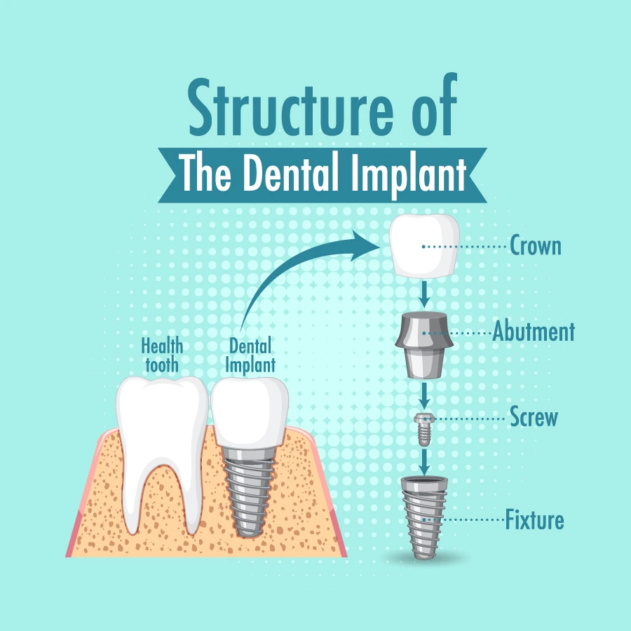 Infographic showing the structure of a dental implant: crown atop an abutment, screw, and fixture, with labeled parts.