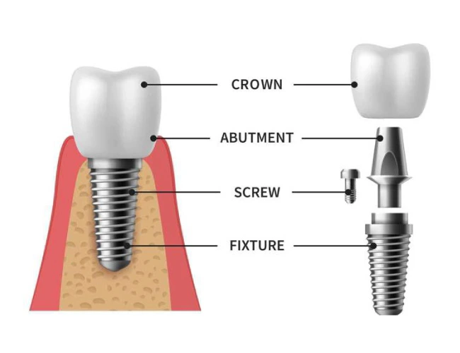 Dental implant diagram showing crown, abutment, screw and fixture placed in the jawbone