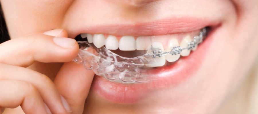 Close-up of a person inserting a clear aligner over braces on the upper teeth.